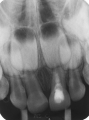 Radiografa periapical, imagen completa de un diente