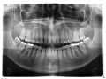 Radiografa panormica, imagen completa de la cavidad bucal
